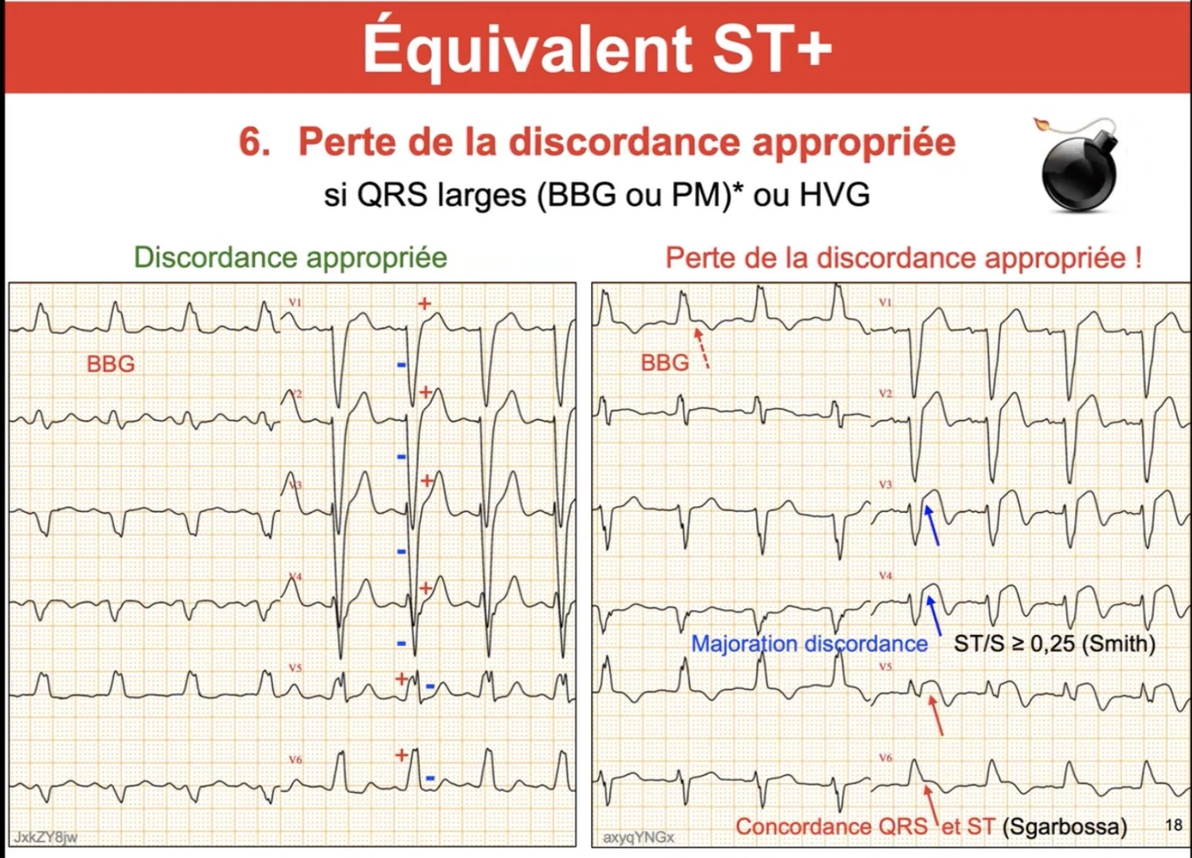 Équivalent ST+ #6 — Perte de la discordance appropriée, comparaison BBG normal vs ischémique