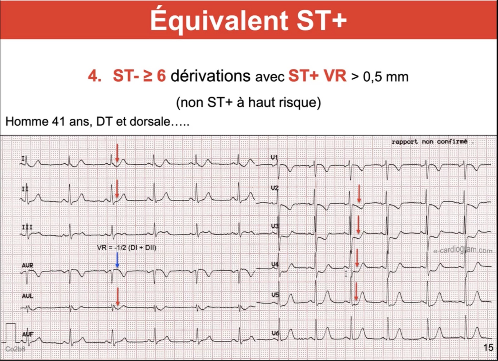 Équivalent ST+ — ST- diffuse 6 dérivations + ST+ aVR, tronc commun