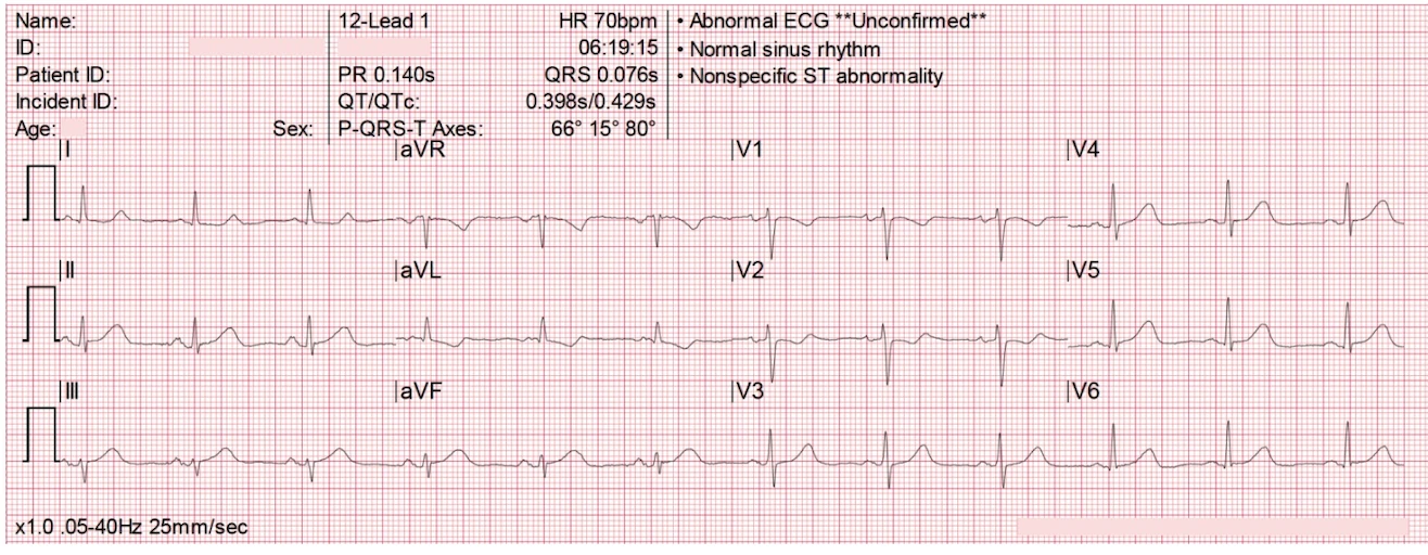 Ondes T hyperaiguës inférieures — T dépasse le QRS en DIII/aVF, ST↓ miroir V1-V3, machine dit nonspecific ST abnormality