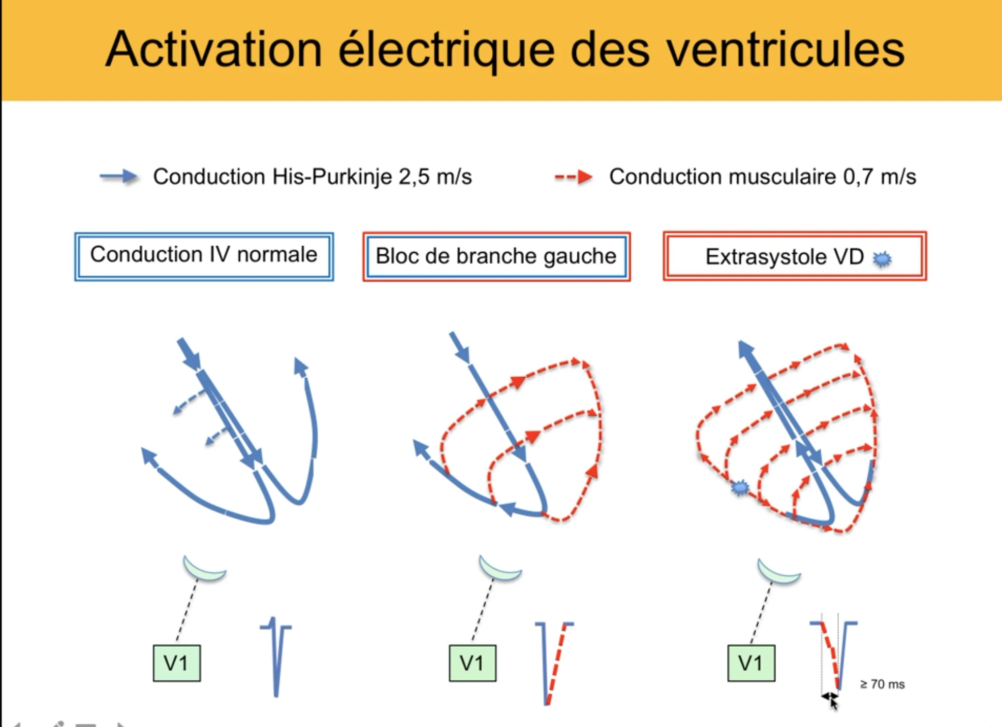 Activation électrique des ventricules — conduction His-Purkinje rapide (bleu, 2,5 m/s) vs conduction musculaire lente (rouge, 0,7 m/s) ; conduction normale, bloc de branche gauche, extrasystole du ventricule droit avec QS en V1 et début ≥ 70 ms