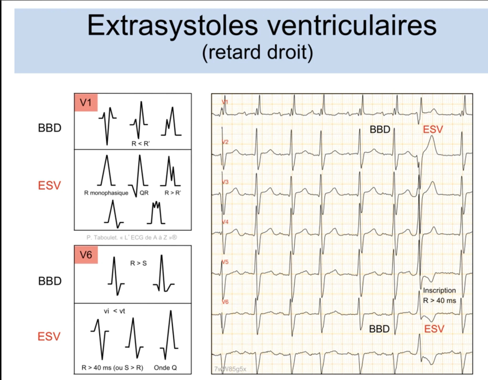 Extrasystoles ventriculaires retard droit — morphologie en V1 (BBD rSR' R<R' vs ESV R monophasique ou R>R') et V6 (BBD R>S vs ESV R>40ms, onde Q, vi<vt), avec exemple 12 dérivations