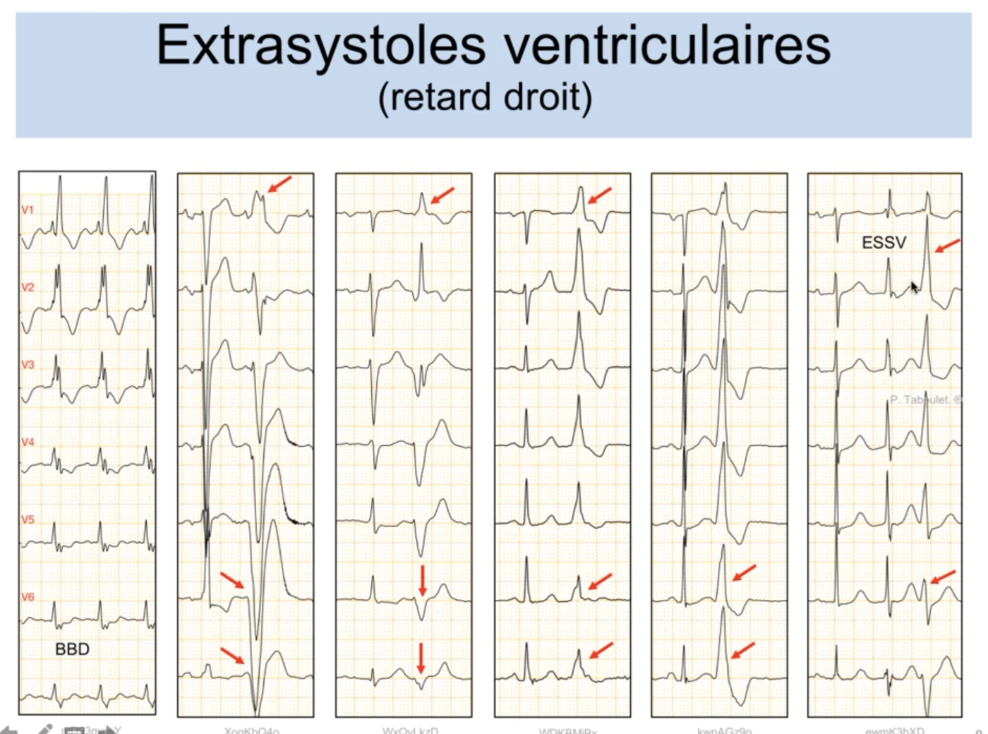 Six exemples d'extrasystoles ventriculaires en retard droit (précordiales V1 à V6) ; colonne 1 = vrai BBD de référence ; colonnes 2 à 6 = ESV avec oreille gauche plus haute, onde Q profonde et R chétive, absence d'onde R en DII, crochetage de la pente descendante, QRS concordant dans les six dérivations et onde R empâtée ou très retardée