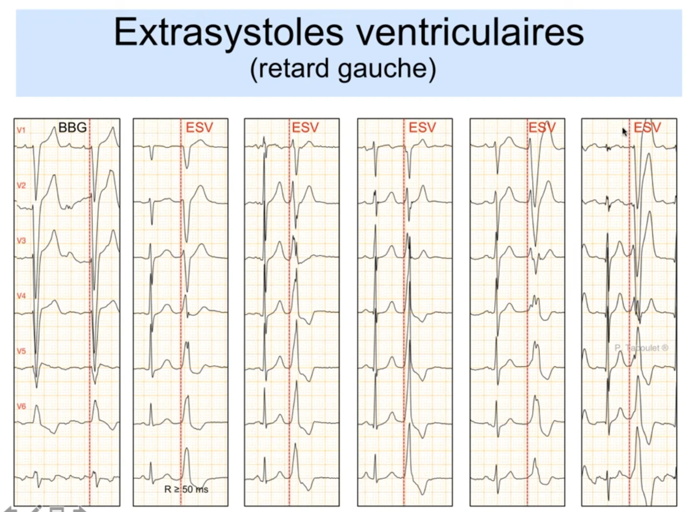 Extrasystoles ventriculaires en retard gauche, six colonnes précordiales V1 à V6 : colonne 1 bloc de branche gauche normal de référence avec début de QRS rapide ; colonnes 2 à 6 extrasystoles ventriculaires avec début empâté et lent, retard à l'activation de l'onde R supérieur à 30-50 ms, onde R monophasique avec retard d'inscription en DII, et QRS triphasique très anormal au début chaotique