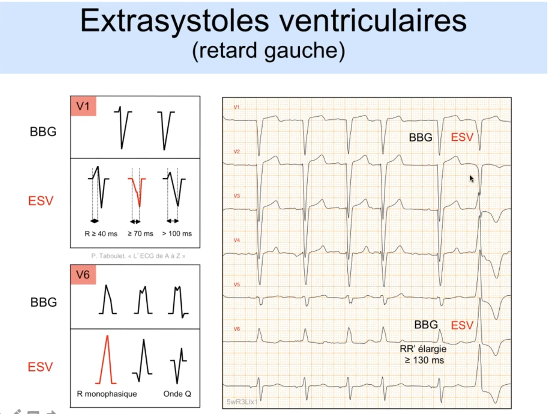 Extrasystoles ventriculaires en retard gauche — critères morphologiques : en V1 le BBG montre un QS fin alors que l'ESV montre une R supérieure ou égale à 40 ms, un nadir de S supérieur ou égal à 70 ms et un QRS de plus de 100 ms ; en V6 le BBG a une R monophasique normale alors que l'ESV a une R monophasique large ou une onde Q ; exemple 12 dérivations BBG versus ESV avec RR prime élargi supérieur ou égal à 130 ms