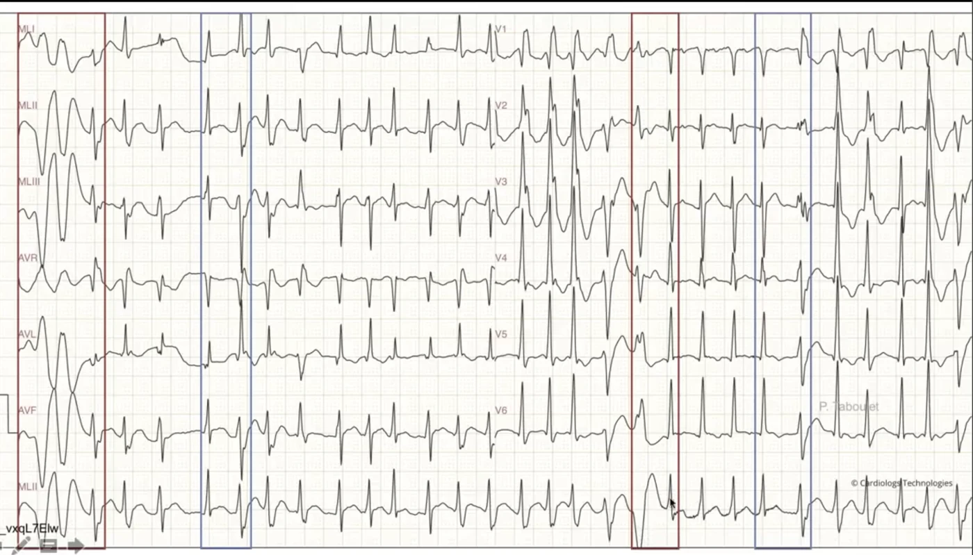 Fibrillation atriale annotée — ESV (encadrés rouges, début du QRS modifié) et aberrations de conduction (encadrés bleus, début du QRS préservé)