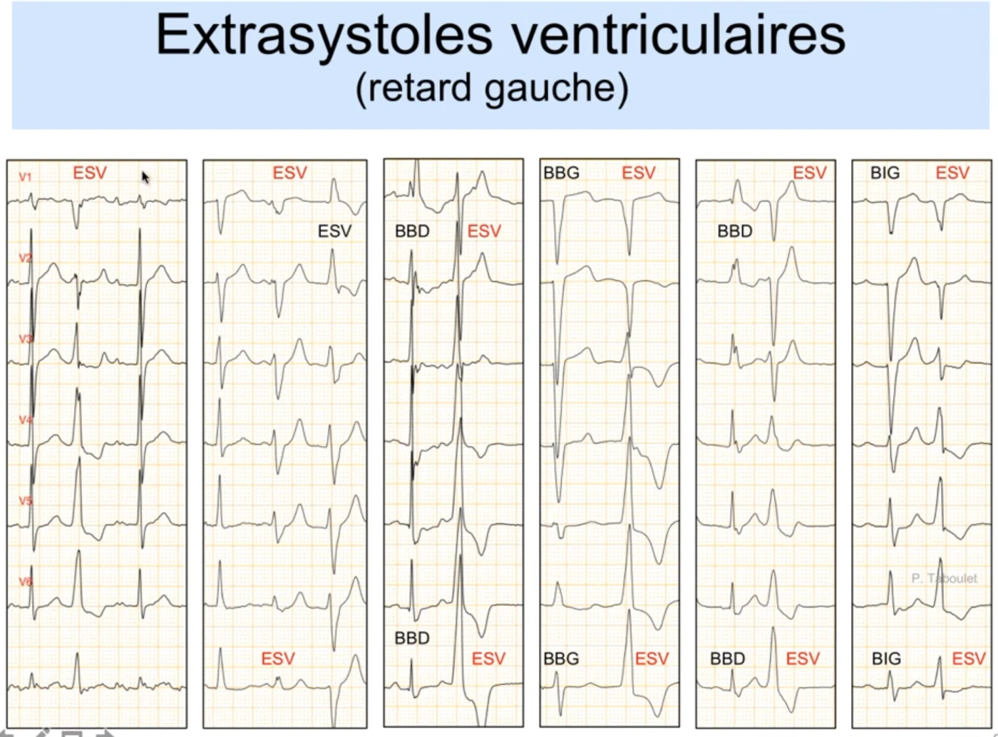 Extrasystoles ventriculaires en retard gauche comparées aux vrais blocs de branche : six colonnes opposant un bloc (BBG, BBD ou BIG) à une ESV ; dans l'ESV le début du QRS en V1-V2 est empâté, crocheté ou à sommet triangulaire, alors que le vrai bloc a un début net et rapide