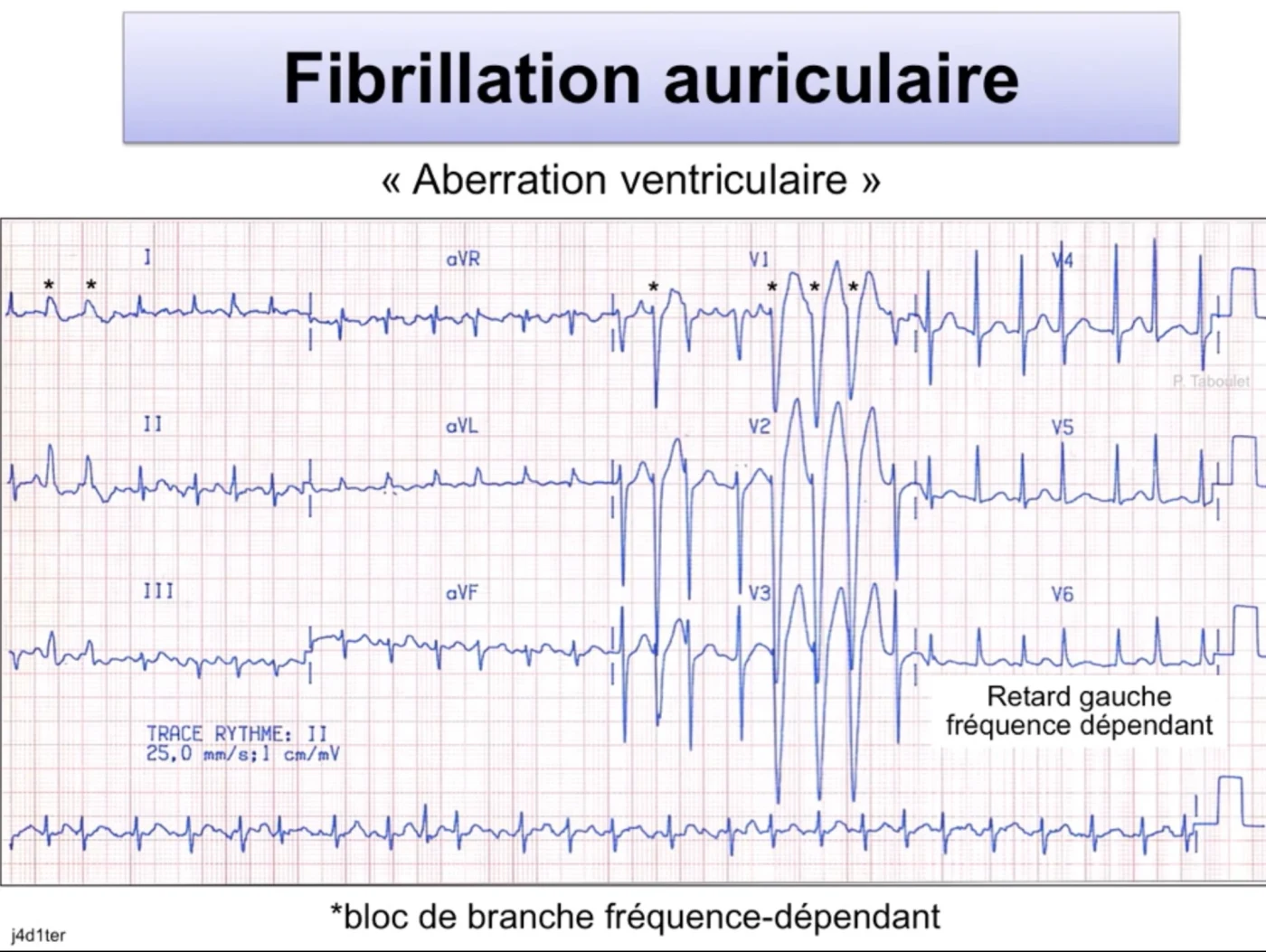 FA avec aberration ventriculaire — retard gauche BBG fréquence-dépendant