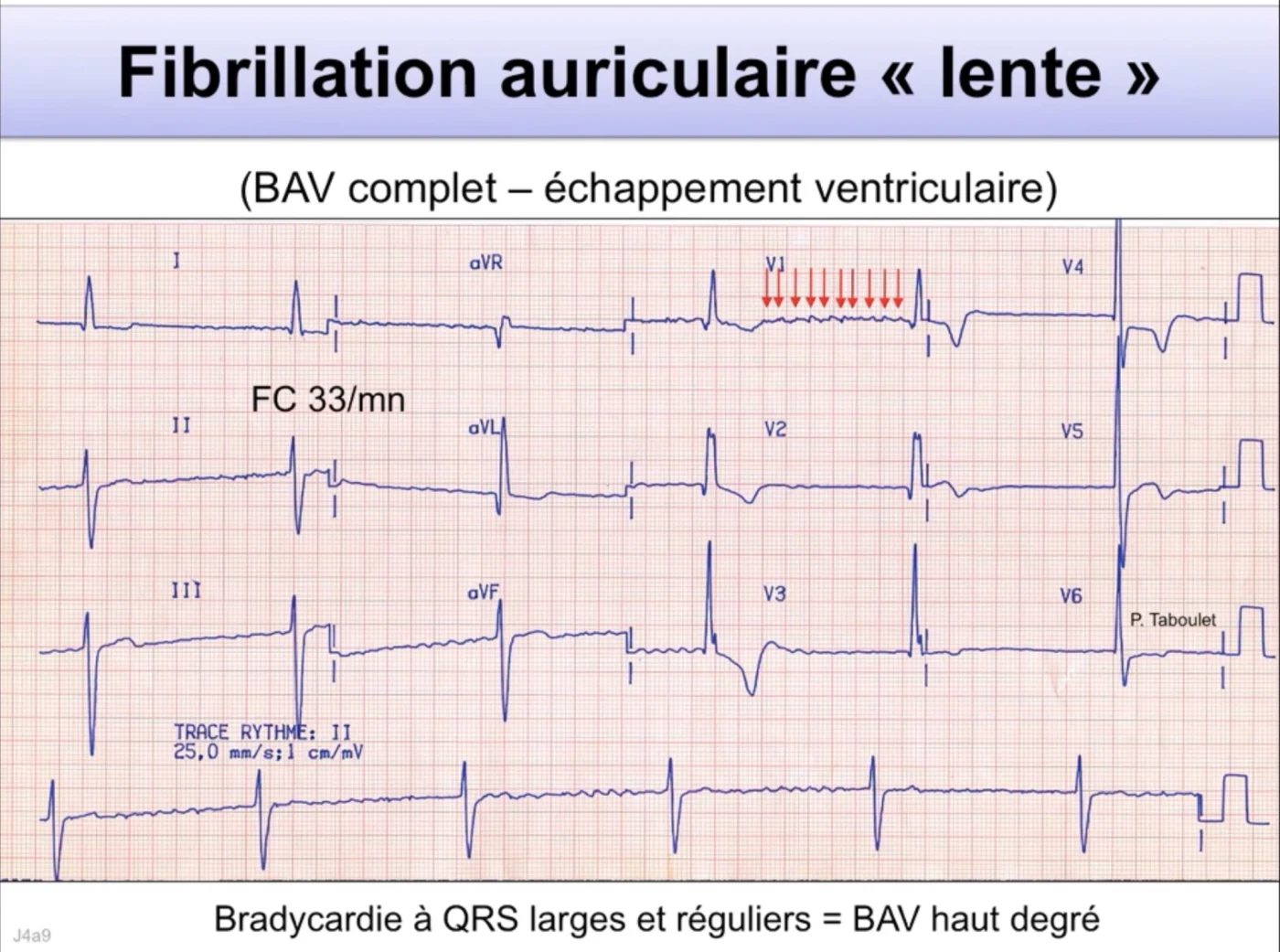 FA lente avec BAV complet — échappement ventriculaire régulier 33/min, QRS larges