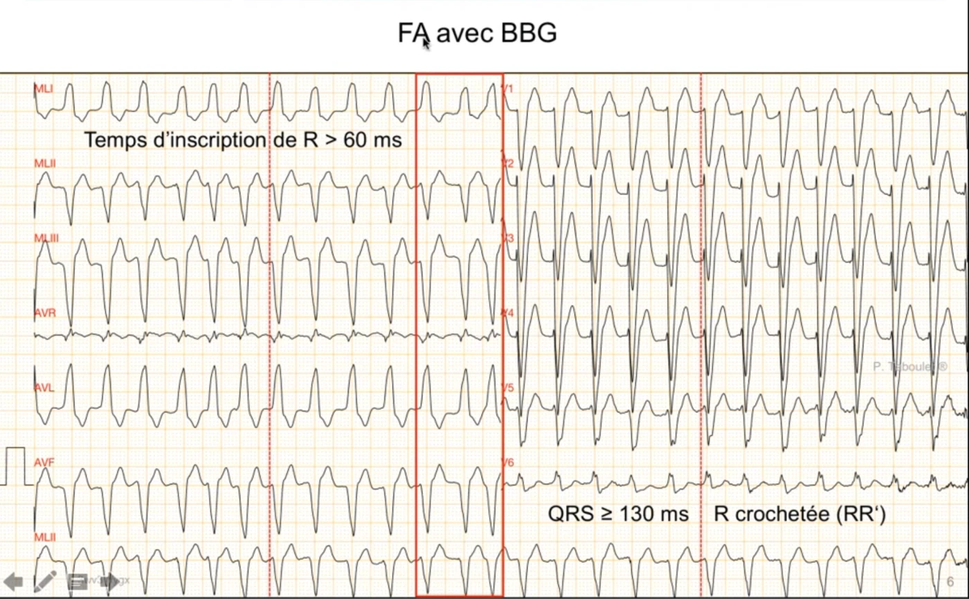 Fibrillation atriale avec bloc de branche gauche d'aspect assez régulier (piège), 12 dérivations : QRS large supérieur ou égal à 130 ms, onde R crochetée RR prime, temps d'inscription de R supérieur à 60 ms dans les dérivations latérales, intervalles RR en réalité irréguliers confirmant une arythmie complète