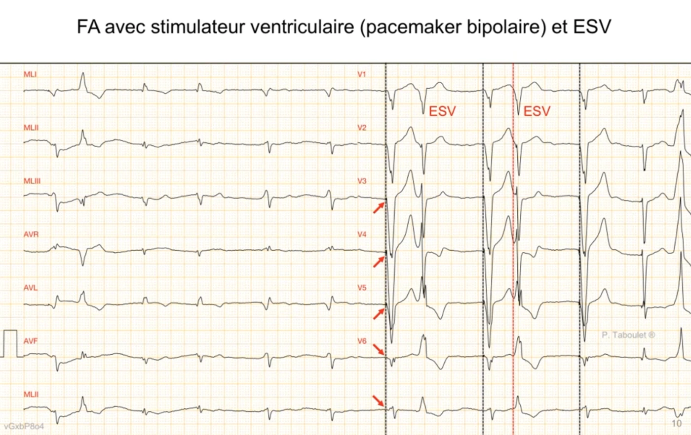 Fibrillation atriale avec extrasystoles ventriculaires multiples : la technique du front de dépolarisation initial montre que presque tous les QRS sont des ESV (retard gauche avec début crocheté en V1-V2 et absence d'onde R en V6, et une ESV retard droit à QRS triphasique empâté), un seul QRS étant supraventriculaire conduit ; les déflexions pointues sont des spikes d'ESV, le ventricule donnant le pace