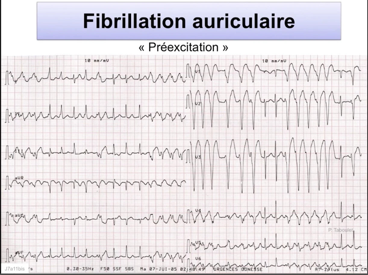 FA préexcitée — QRS larges irréguliers, préexcitation variable