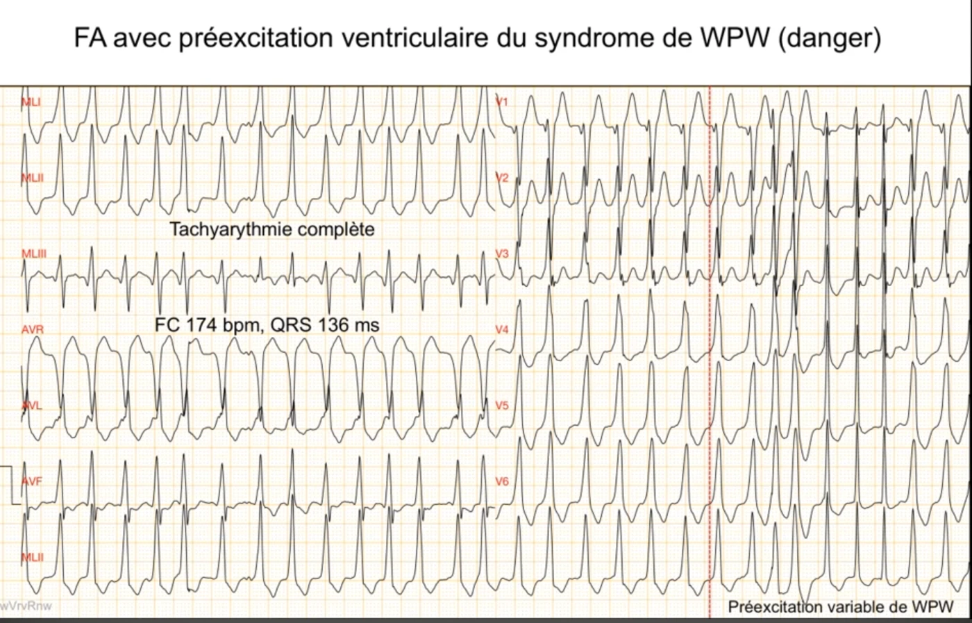 FA avec préexcitation ventriculaire du syndrome de WPW, tachyarythmie complète à 174 par minute avec QRS larges de 136 ms ; anomalie en V1 V2 V3 qui n'est pas un bloc de branche gauche car la largeur des QRS n'est pas constante, traduisant une préexcitation variable où chaque complexe est une fusion variable entre la conduction par le nœud et par le faisceau de Kent