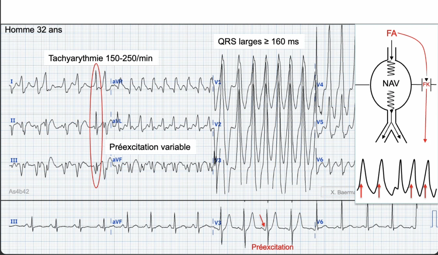 Homme de 32 ans — fibrillation atriale préexcitée : tachyarythmie irrégulière à 150-250 par minute, QRS larges supérieurs ou égaux à 160 ms de largeur variable (préexcitation variable), avec schéma montrant la FA qui descend à la fois par le nœud auriculo-ventriculaire et par le faisceau de Kent ; bande du bas en rythme sinusal révélant une onde delta de préexcitation