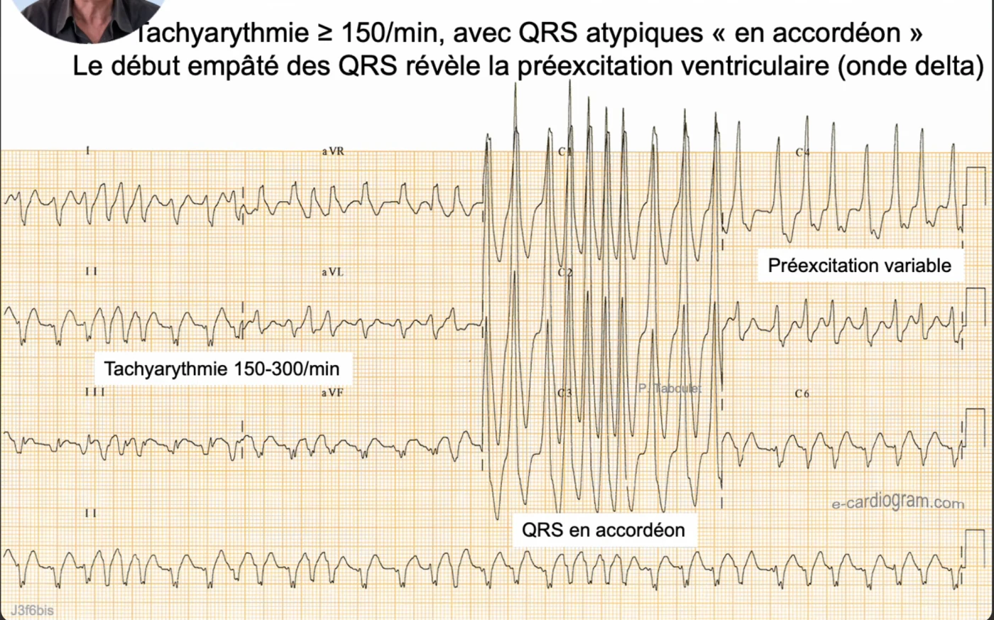 Fibrillation atriale préexcitée — tachyarythmie irrégulière supérieure ou égale à 150 par minute (150 à 300 par minute), QRS atypiques dits « en accordéon » dont la largeur varie d'un complexe à l'autre ; le début empâté des QRS traduit l'onde delta de préexcitation ventriculaire variable par le faisceau de Kent
