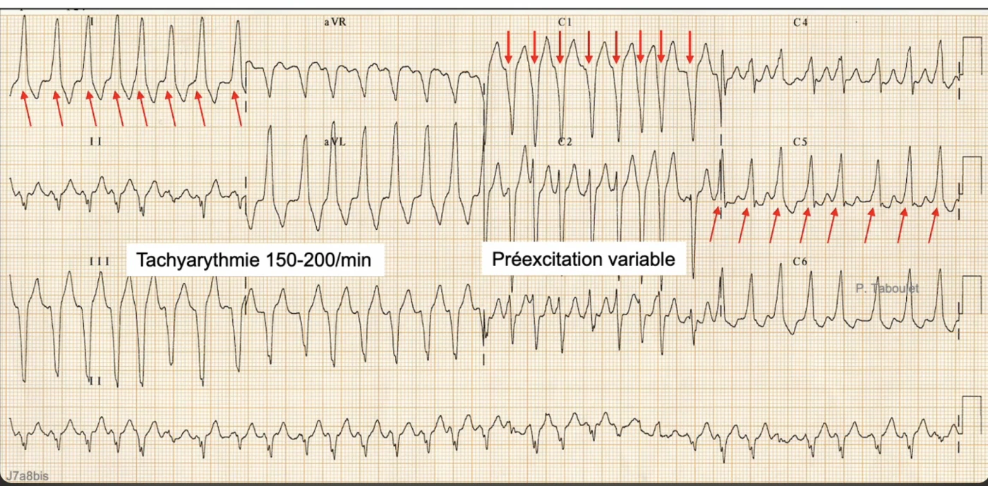 Fibrillation atriale préexcitée à 150-200 par minute sur douze dérivations : tachyarythmie irrégulière avec préexcitation variable, ondes delta signalées par des flèches rouges au début empâté des QRS dont la largeur varie d'un complexe à l'autre