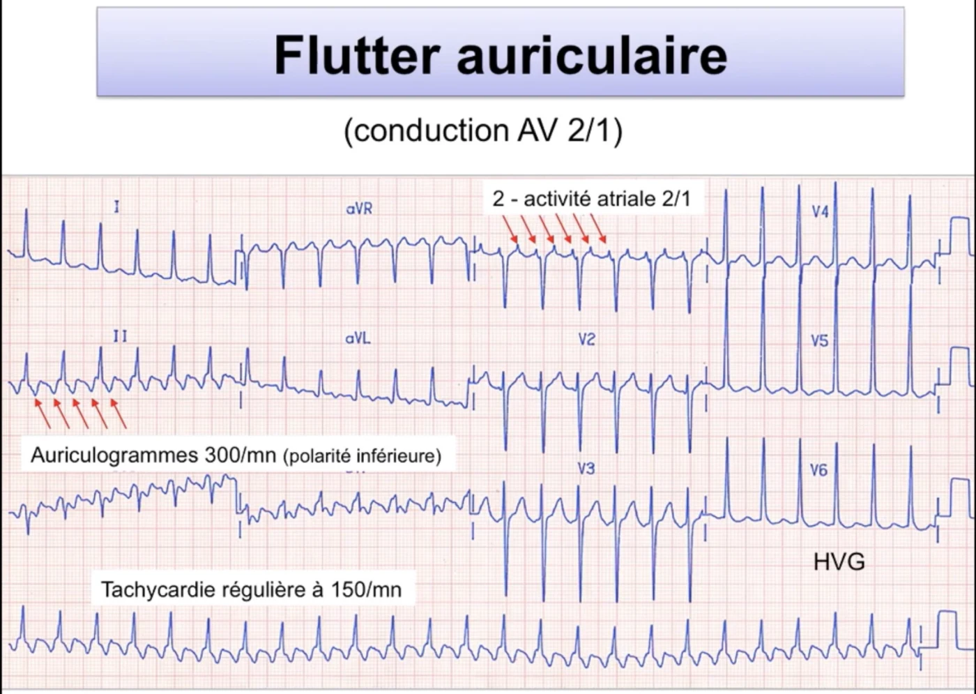 Flutter auriculaire conduction 2:1 — auriculogrammes 300/min, tachycardie régulière 150/min