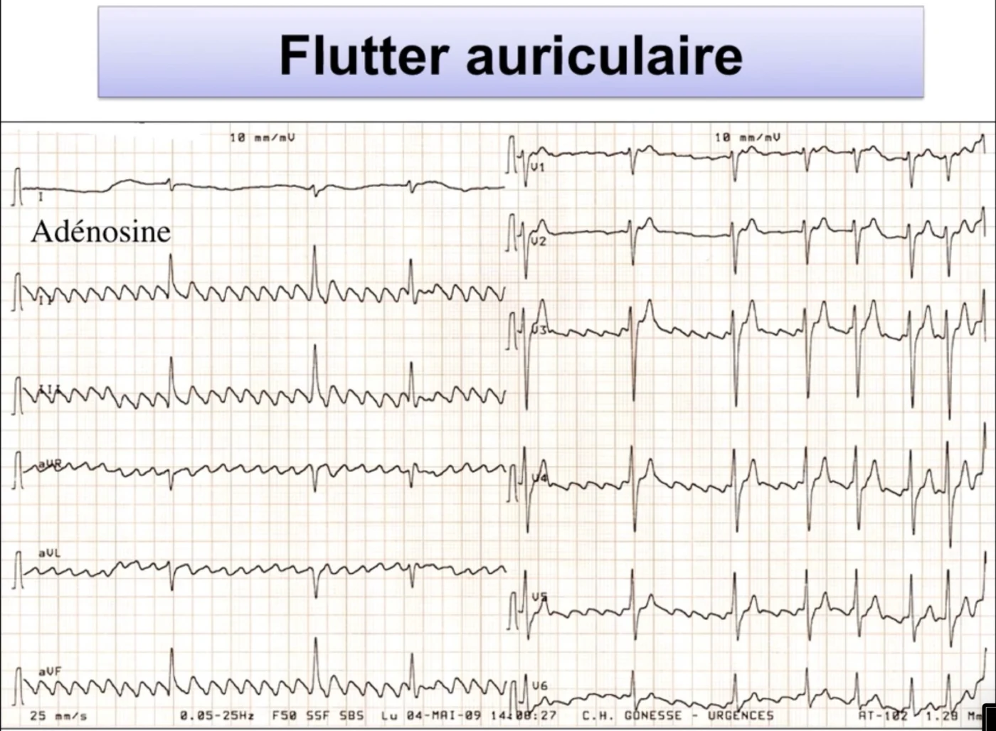 Flutter démasqué par adénosine — les ondes F apparaissent quand le nœud AV est bloqué