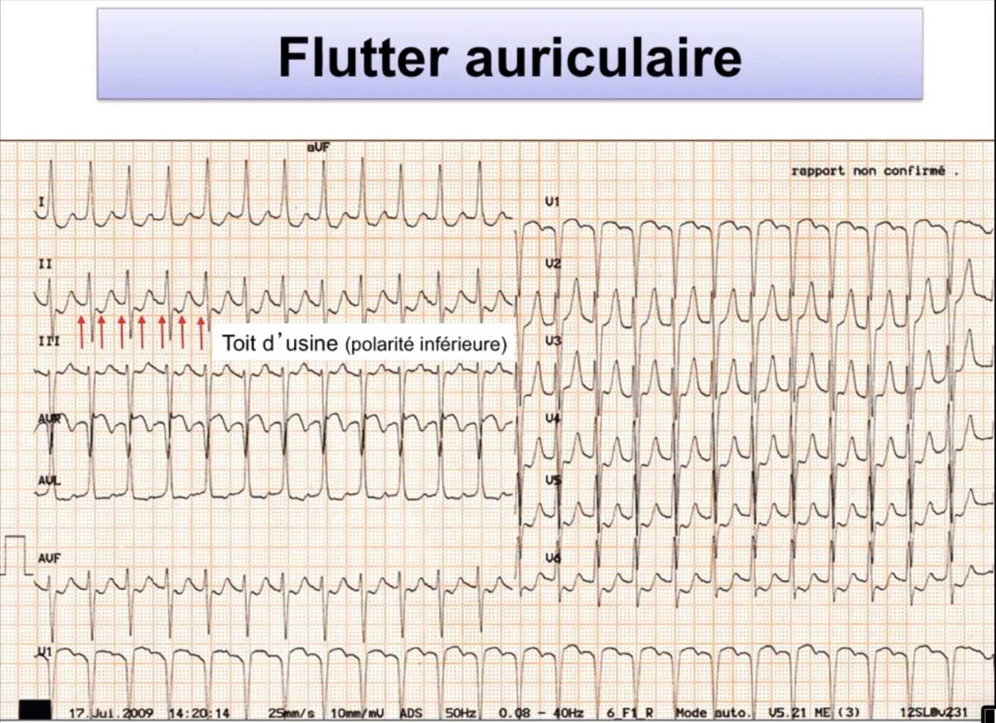 Flutter auriculaire — ondes F en toit d'usine, polarité inférieure négative