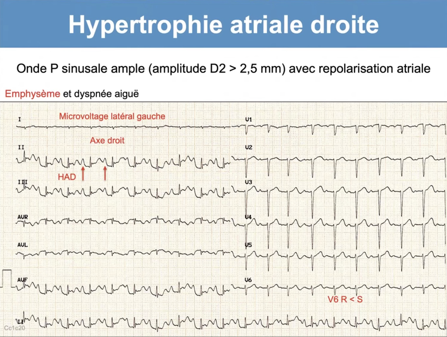 HAD avec repolarisation atriale visible — emphysème, axe droit, microvoltage
