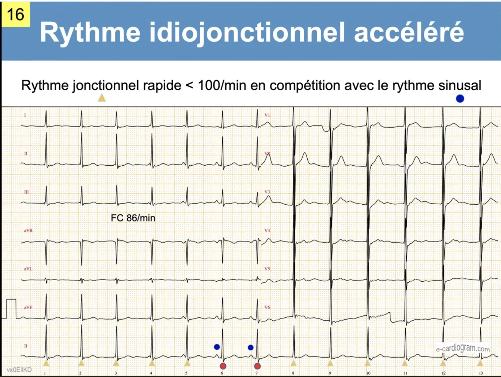 Rythme jonctionnel en compétition avec rythme sinusal