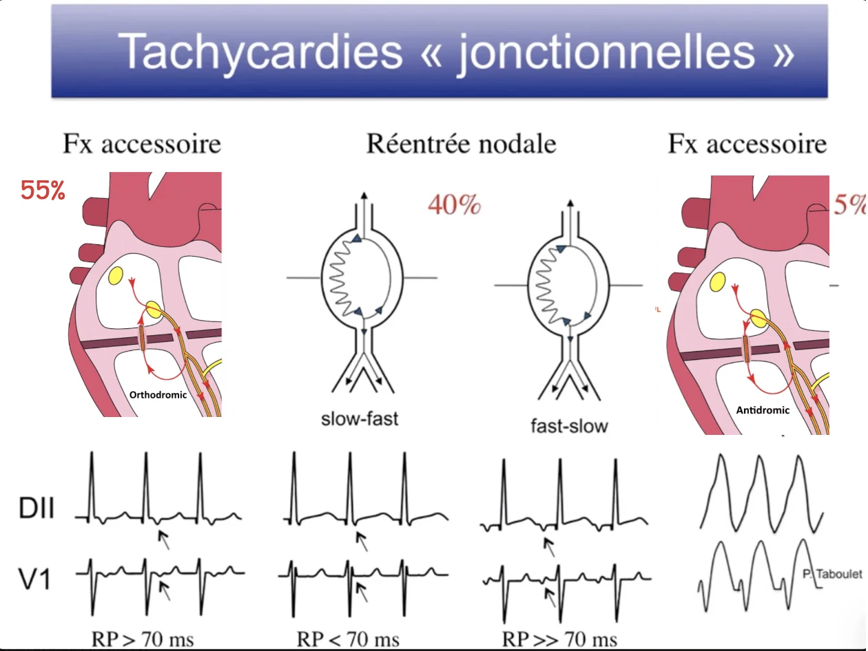 Tachycardies jonctionnelles — les 4 circuits : TRAV orthodromique (fréquente, Kent, RP > 70 ms), TRIN slow-fast (fréquente, réentrée nodale, RP < 70 ms), TRIN fast-slow (rare, RP >> 70 ms), TRAV antidromique (rare, QRS large)