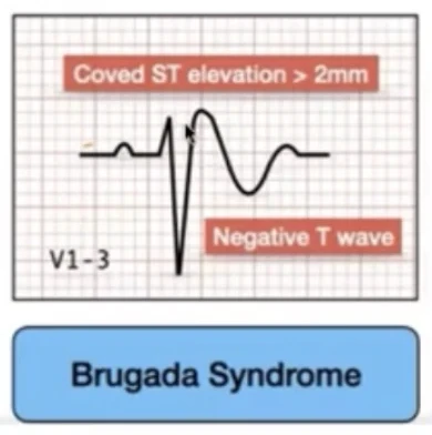 Brugada — sus-décalage ST en dôme V1-V3, T négative