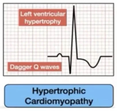 CMH — HVG et ondes Q en dague latérales