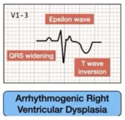 DAVD — onde epsilon, QRS élargi, T négatives V1-V3