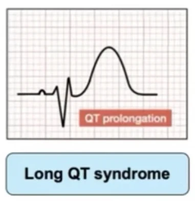 QT long — allongement du segment QT