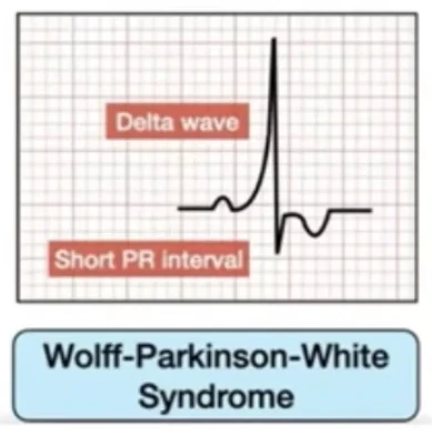 WPW — onde delta et PR court
