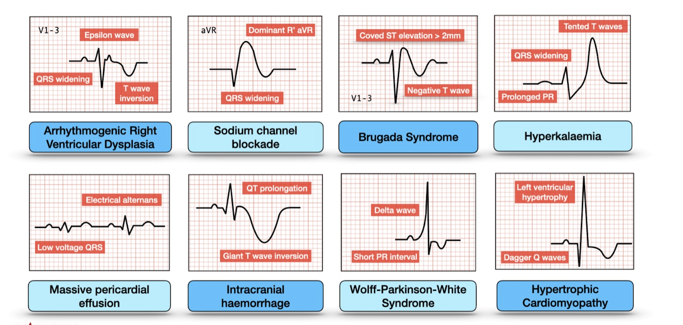 8 ECG killers — DAVD, bloc sodique, Brugada, hyperkaliémie, épanchement, HIC, WPW, CMH