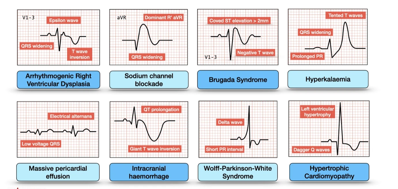 8 ECG killers — DAVD, bloc sodique, Brugada, hyperkaliémie, épanchement, HIC, WPW, CMH