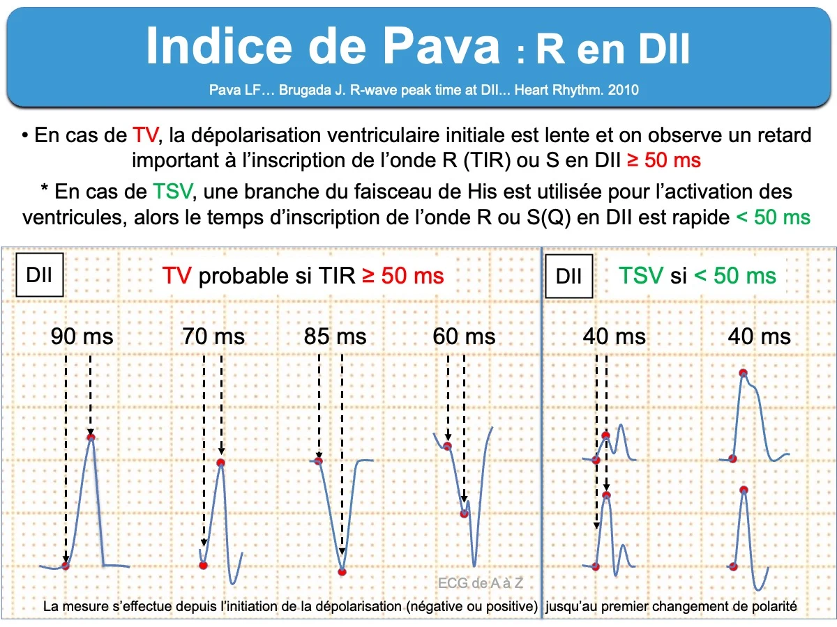 Indice de Pava — temps d'inscription de l'onde R en DII : ≥ 50 ms = TV probable (départ lent), < 50 ms = TSV (activation par une branche du His)