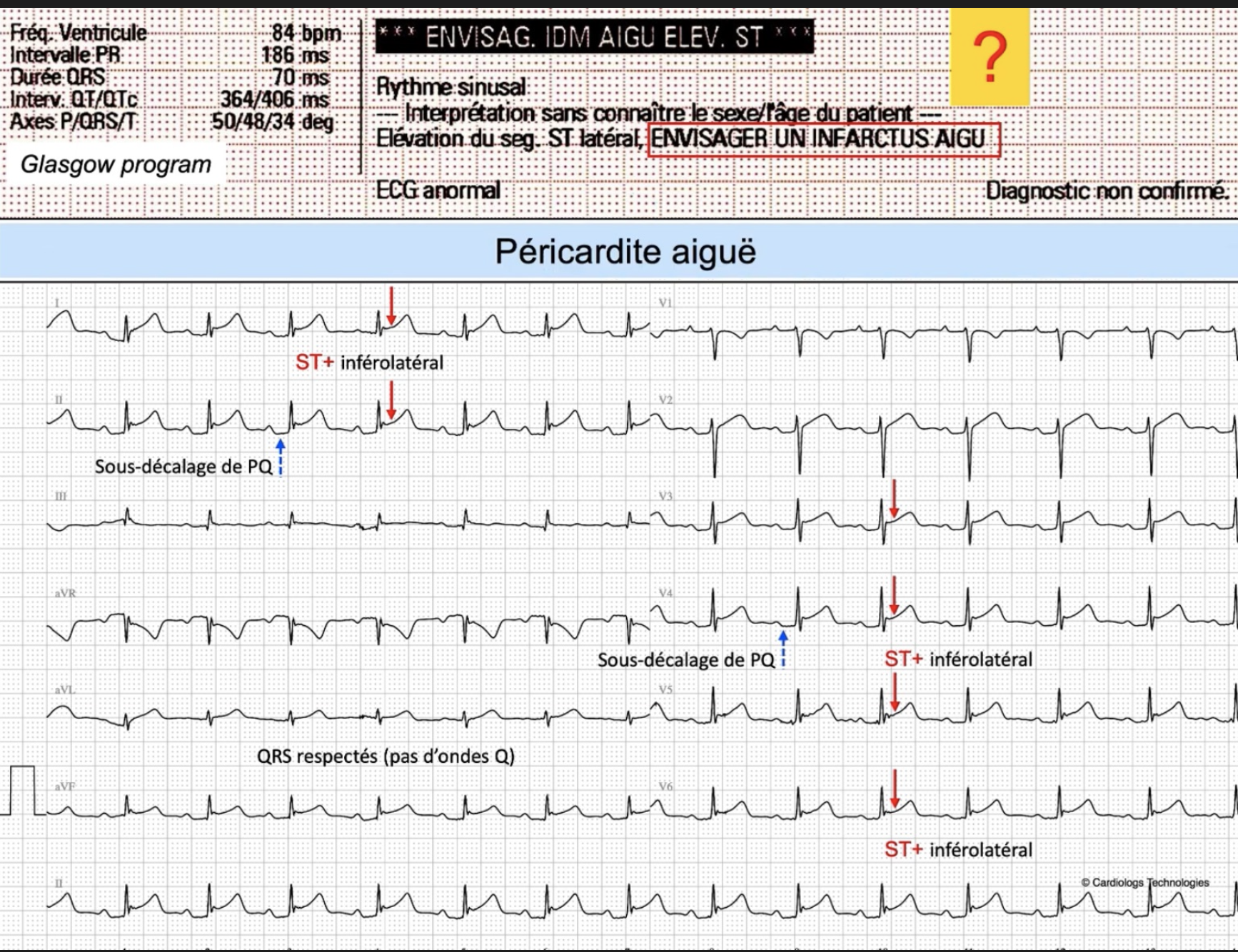 Péricardite aiguë — machine conclut ENVISAGER INFARCTUS AIGU, PQ↓, QRS respectés