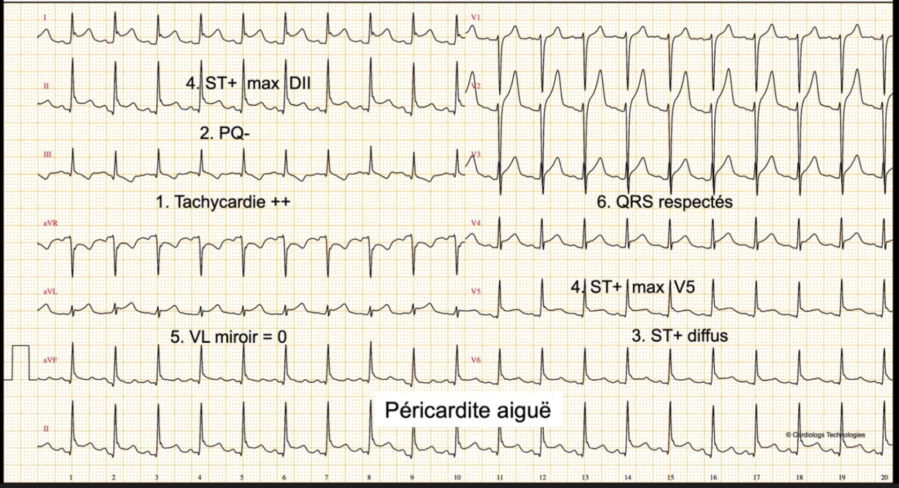 Péricardite aiguë — ST+ diffus, PQ négatif, tachycardie, aVL miroir = 0, QRS respectés