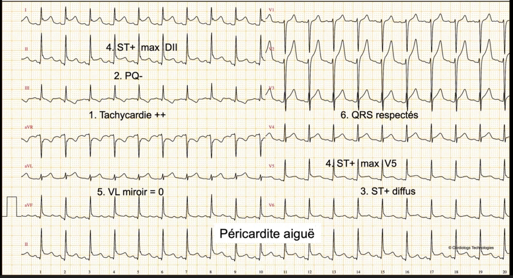 Péricardite aiguë — ST+ diffus, PQ négatif, tachycardie, aVL miroir = 0, QRS respectés