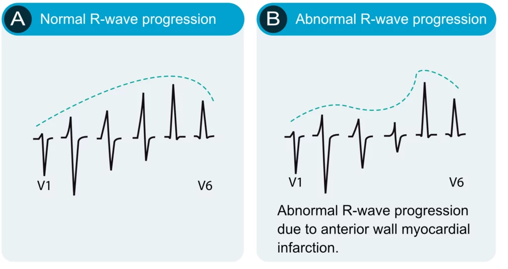 Progression des ondes R en précordiales V1 à V6 — (A) progression normale, R croissante ; (B) progression anormale par infarctus du myocarde de la paroi antérieure, R restant basses