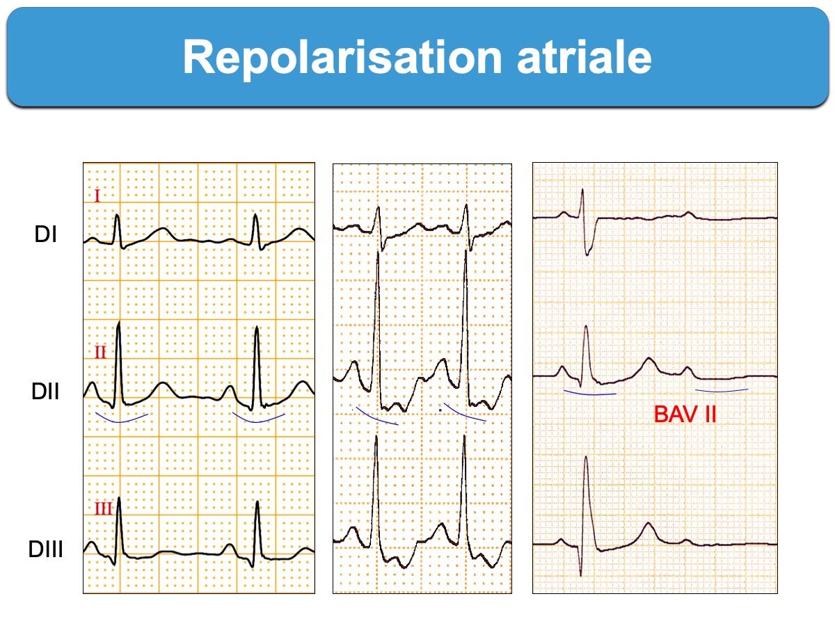 Repolarisation atriale — onde Ta visible sous la ligne de base en DI, DII, DIII