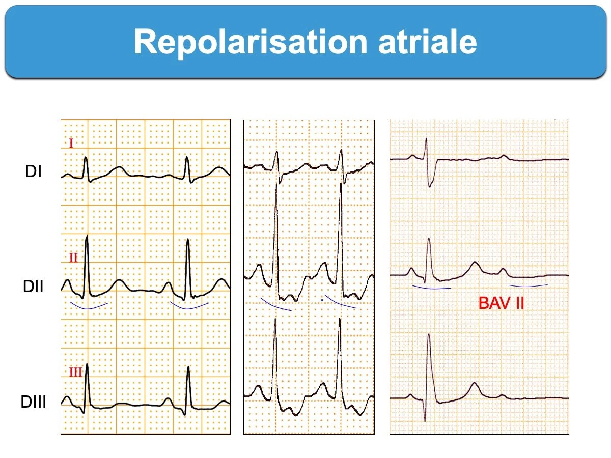 Repolarisation atriale — onde Ta visible sous la ligne de base en DI, DII, DIII