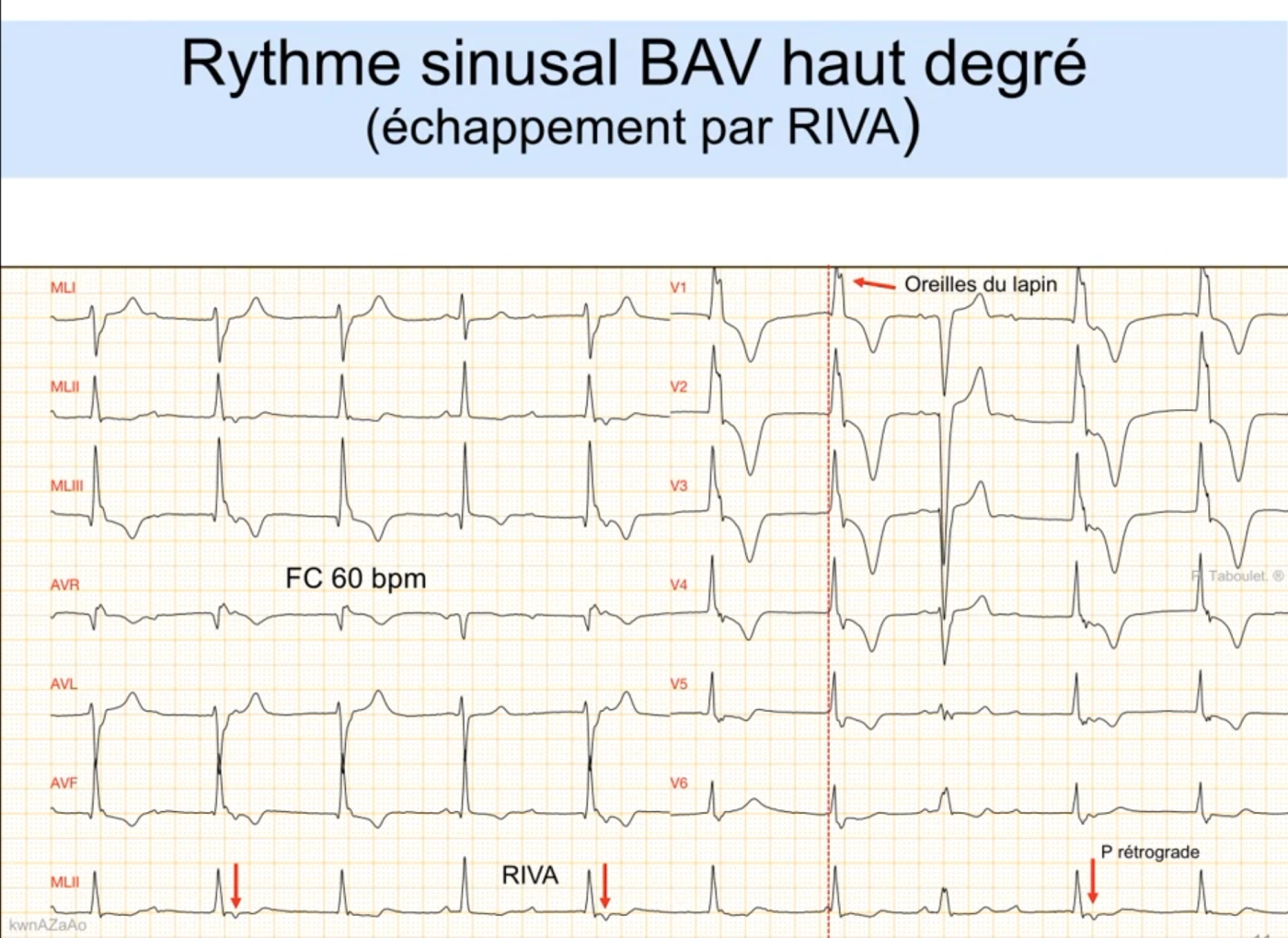 RIVA sur BAV de haut degré — ECG 12 dérivations, fréquence 60/min, QRS large d'origine ventriculaire avec signe de l'oreille du lapin en V1, ondes P sinusales dissociées signalées par des flèches, et onde P rétrograde après certains QRS témoignant d'une conduction ventriculo-atriale