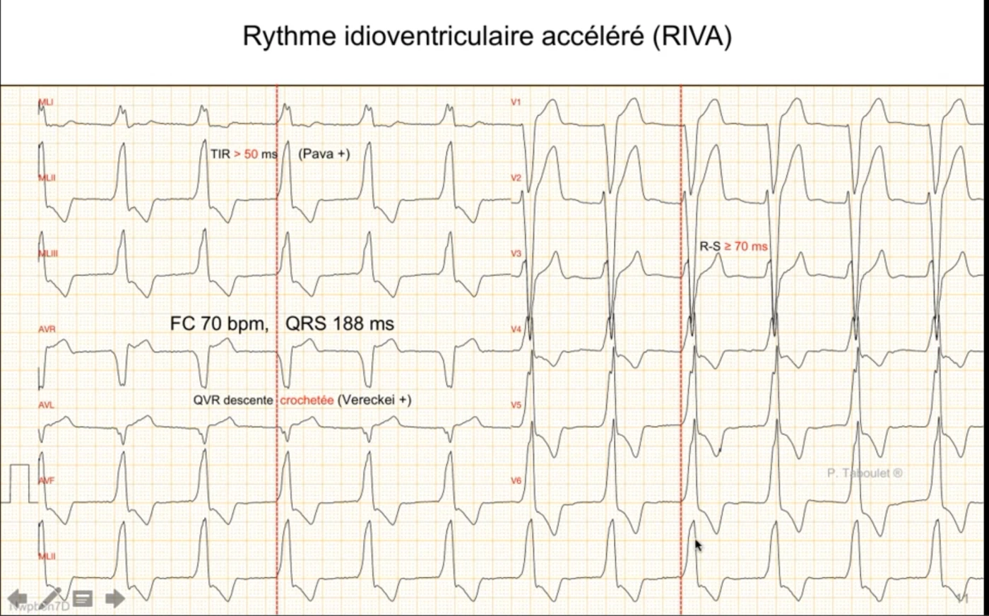Rythme idioventriculaire accéléré (RIVA) sur 12 dérivations, fréquence 70 par minute, QRS large à 188 ms : temps d'inscription de l'onde R en DII supérieur à 50 ms (signe de Pava positif), descente de la R en aVR crochetée (Vereckei positif), intervalle R-S supérieur ou égal à 70 ms, sans onde P, QRS ectopique