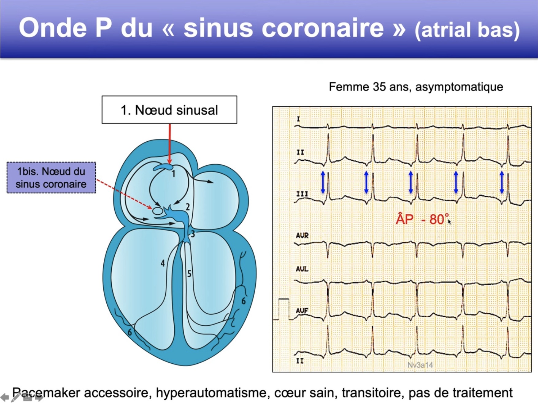 Onde P du sinus coronaire — schéma anatomique nœud 1bis + ECG P négative DII/DIII, axe P −80°