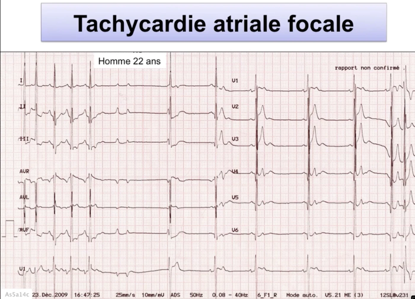 Tachycardie atriale focale — ECG 12 dérivations, homme 22 ans
