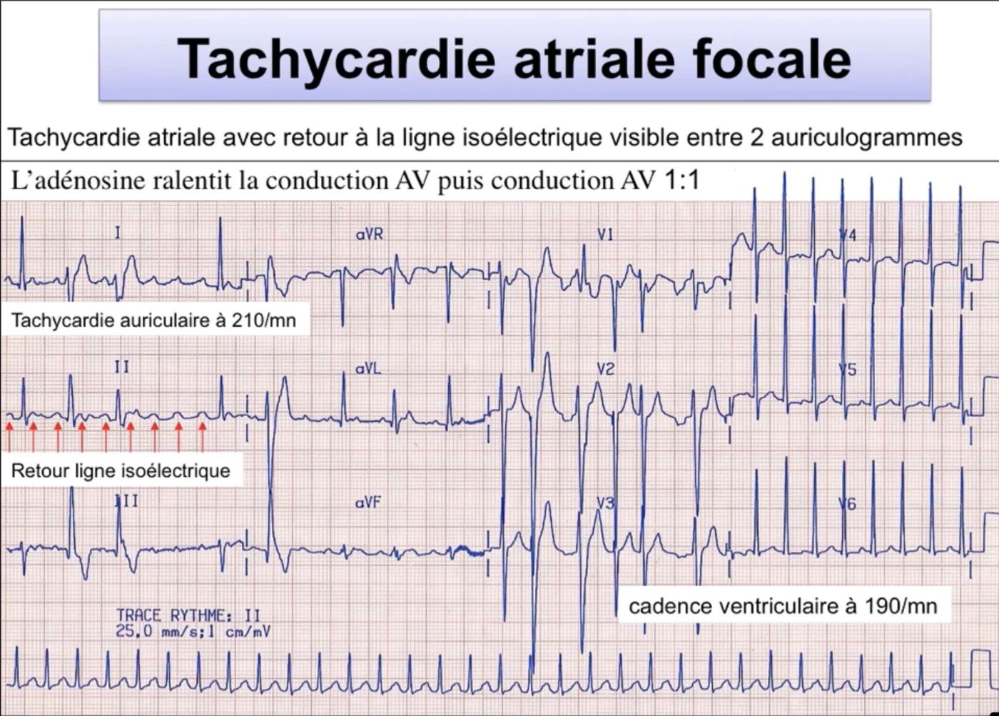 Tachycardie atriale focale démasquée par adénosine — P′ avec retour à la ligne isoélectrique, auriculaire 210/min