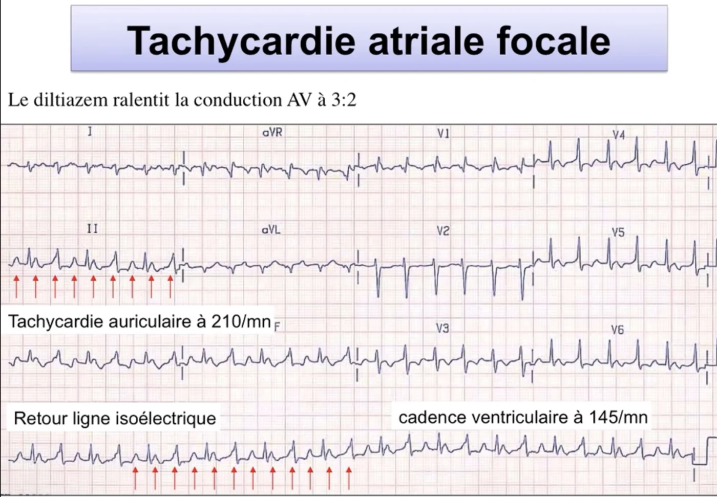 Tachycardie atriale focale — diltiazem, conduction AV 3:2, ventricule 145/min, auriculaire 210/min