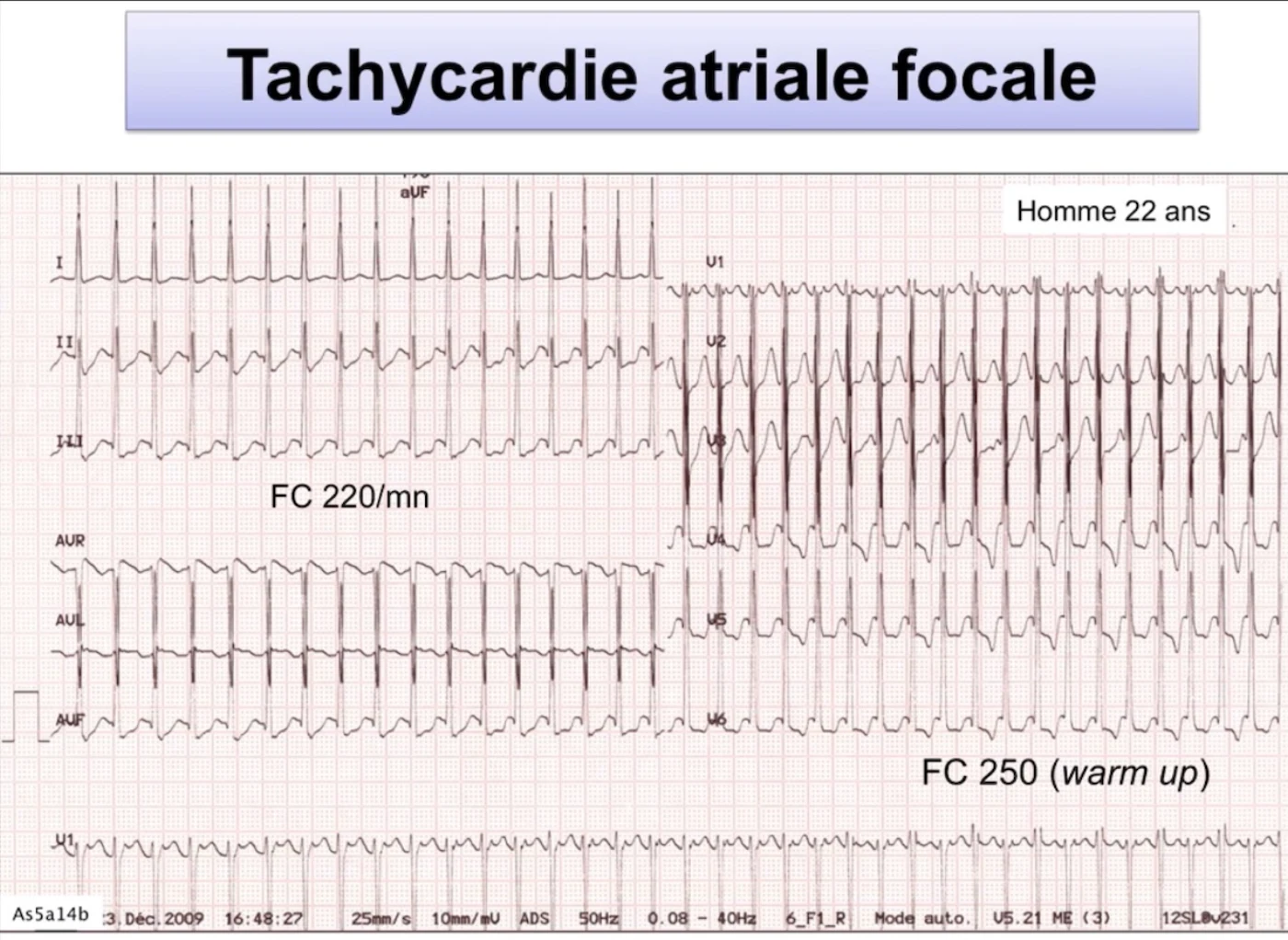 Tachycardie atriale focale — phénomène de warm-up, accélération 220 à 250/min, homme 22 ans