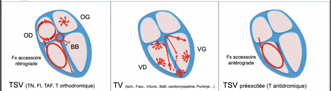 Trois schémas du cœur comparant les mécanismes d'une tachycardie à QRS large. À gauche une TSV supraventriculaire : tachycardie nodale jonctionnelle, flutter dans l'oreillette droite, tachycardie atriale focale dans l'oreillette gauche, ou tachycardie orthodromique du Wolff-Parkinson-White où l'influx remonte par le faisceau accessoire rétrograde, le QRS n'étant large que par un bloc de branche associé. Au milieu une TV naissant du ventricule droit ou gauche : causes ischémique, fasciculaire, infundibulaire, branche à branche, cardiomyopathie, Purkinje. À droite une TSV préexcitée ou tachycardie antidromique du Wolff-Parkinson-White où l'influx descend par le faisceau accessoire antérograde de Kent et dépolarise d'abord le ventricule