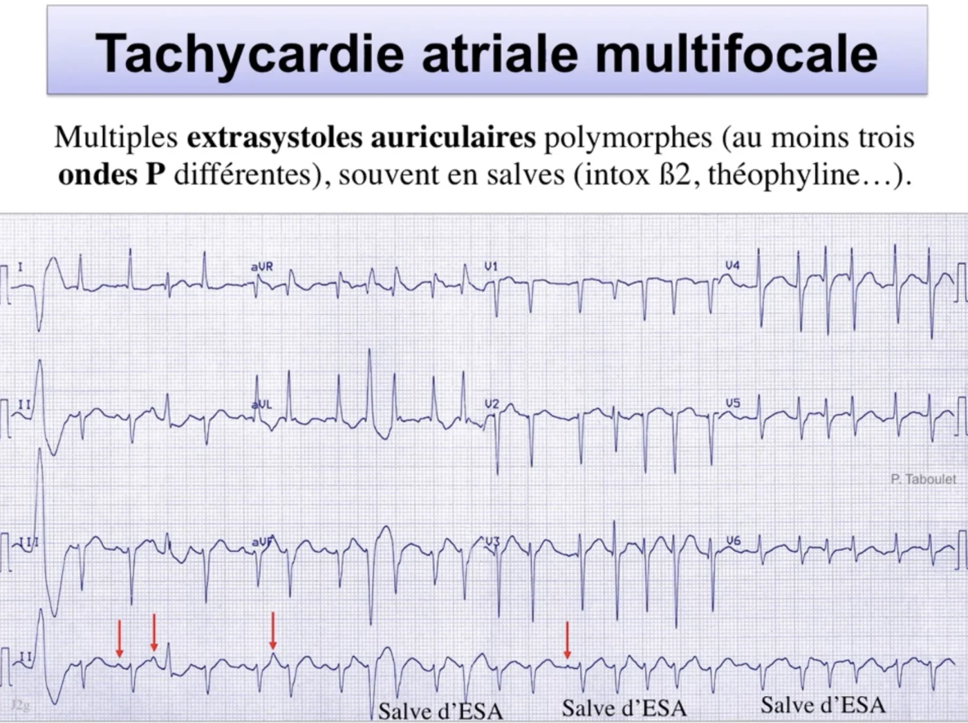 Tachycardie atriale multifocale — au moins 3 ondes P polymorphes, salves d'extrasystoles auriculaires