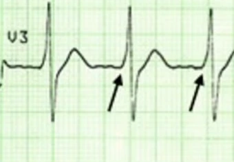 Zoom sur la dérivation V3 après cardioversion : onde delta de préexcitation, empâtement initial du QRS marqué par des flèches