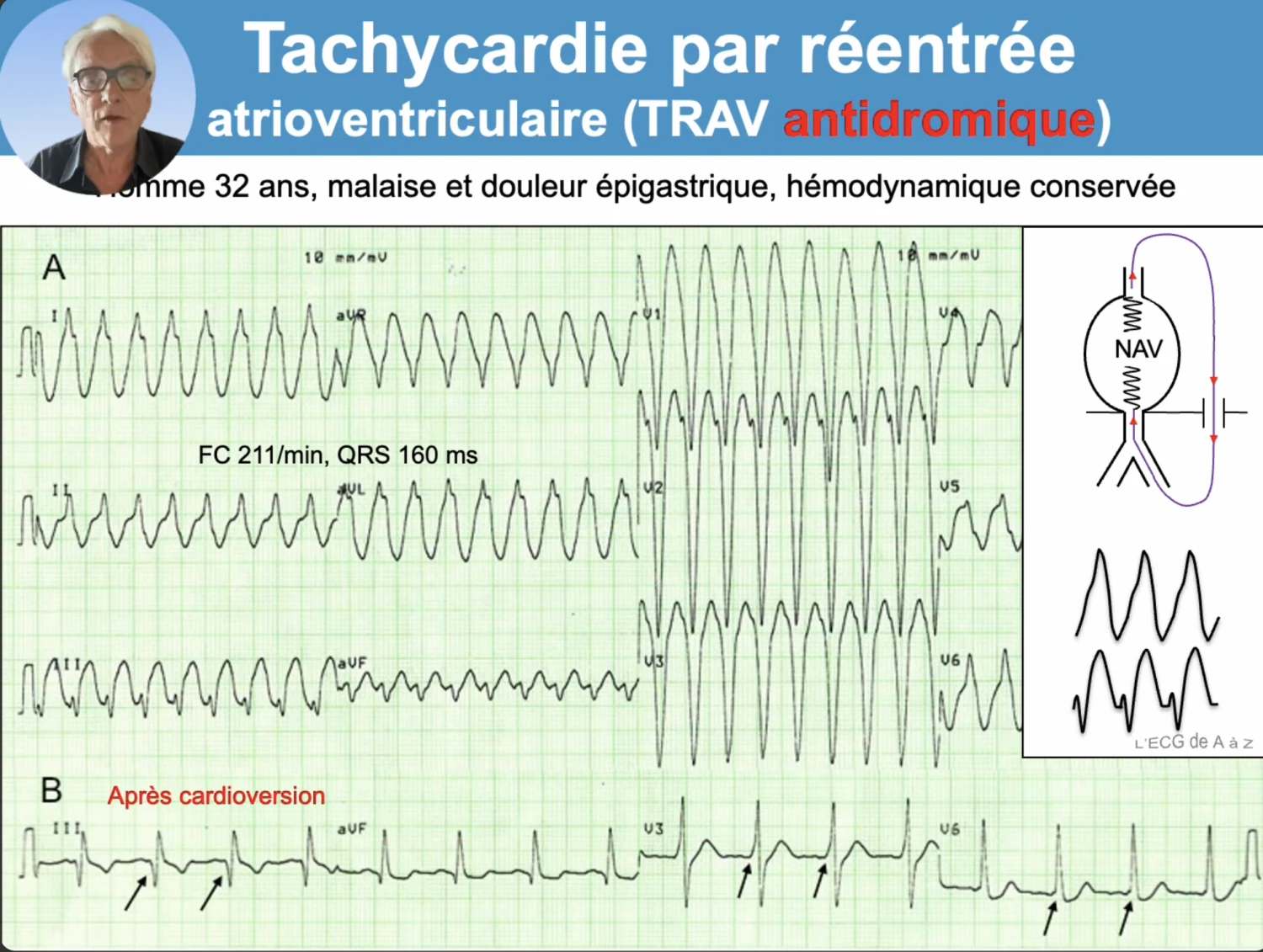 Tachycardie par réentrée atrioventriculaire antidromique chez un homme de 32 ans (malaise et douleur épigastrique, hémodynamique conservée). Panel A : tachycardie régulière à QRS large de 160 ms, fréquence 211 par minute, d'allure de tachycardie ventriculaire, avec schéma du circuit descendant par le faisceau de Kent et remontant par le nœud auriculo-ventriculaire. Panel B après cardioversion : rythme sinusal montrant une préexcitation avec onde delta signalée par des flèches, nette en V3 ainsi qu'en DIII, aVF et V6, révélant le syndrome de Wolff-Parkinson-White
